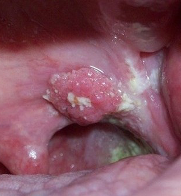 Ung thư khoang miệng: Nguyên nhân, triệu chứng, phòng ngừa và điều trị- Ảnh 2.