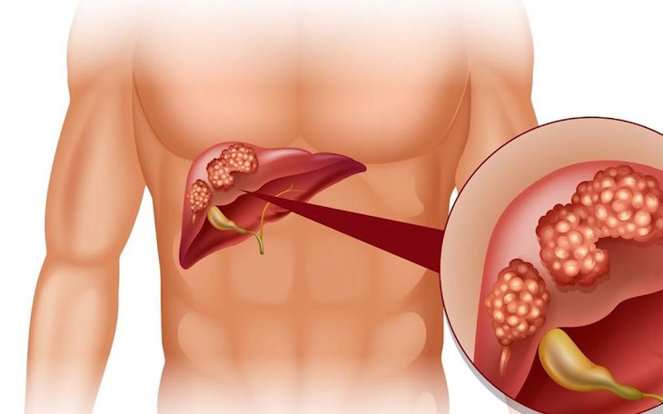 Biểu hiện của bệnh viêm gan ở giai đoạn đầu