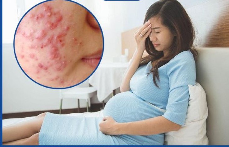 Khắc phục mụn trứng cá ở phụ nữ mang thai- Ảnh 1. Khắc phục mụn trứng cá ở phụ nữ mang thai- Ảnh 1.