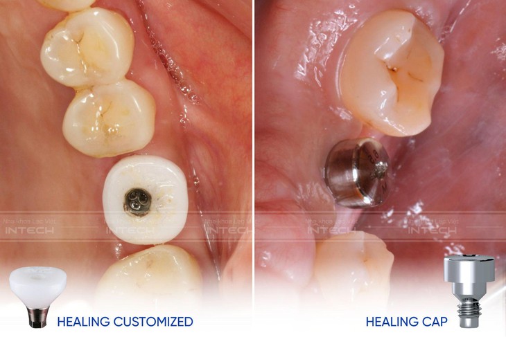 Trồng răng implant công nghệ mới: Tại sao phải sử dụng trụ lành thương giải phẫu cá nhân hóa?- Ảnh 2.