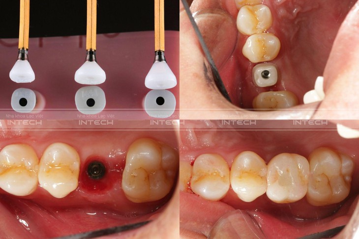 Trồng răng implant công nghệ mới: Tại sao phải sử dụng trụ lành thương giải phẫu cá nhân hóa?- Ảnh 3.