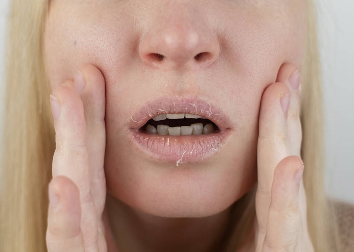 Khô môi do thiếu chất gì?- Ảnh 1. Khô môi do thiếu chất gì?- Ảnh 1.