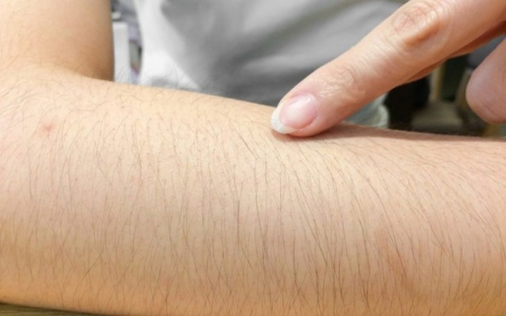 Rậm lông: Nguyên nhân, triệu chứng, chẩn đoán và điều trị