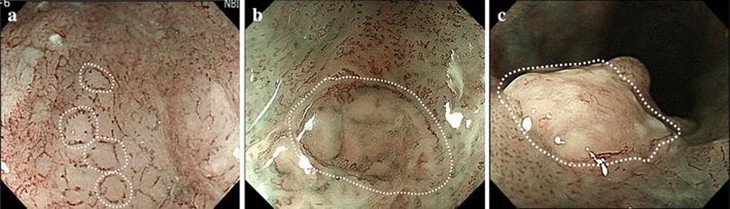 Ung thư thực quản: Nguyên nhân, triệu chứng, cách phòng ngừa và điều trị- Ảnh 3.