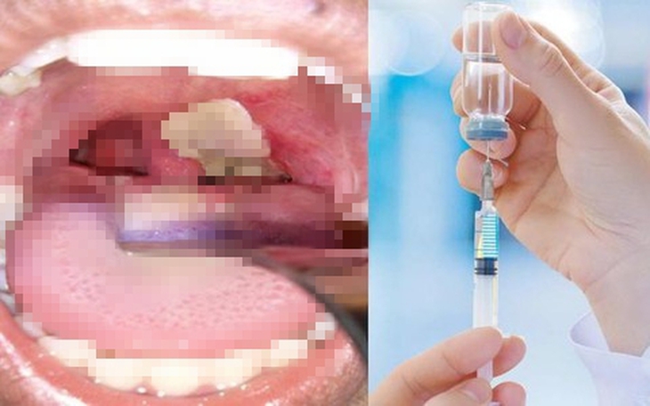 Đã có ca tử vong do bạch hầu, Bộ Y tế yêu cầu giám sát, phát hiện sớm, xử lý triệt để ổ dịch