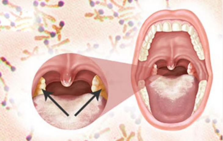 8 người tiếp xúc gần với bệnh nhân mắc Bạch hầu ở Bắc Giang đều âm tính- Ảnh 1.