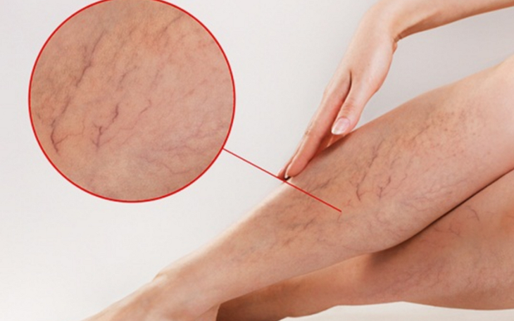 6 dấu hiệu cảnh báo suy giãn tĩnh mạch chân