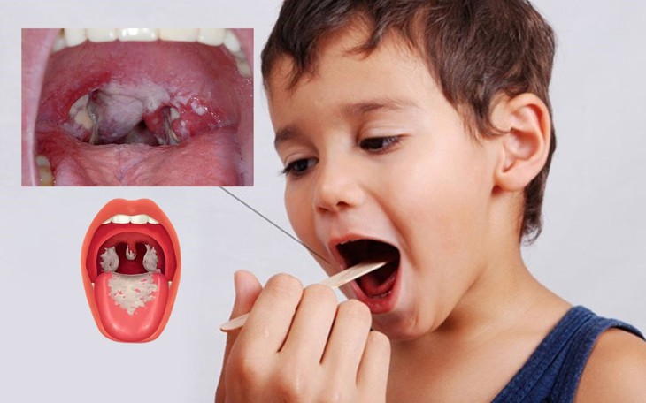 Dấu hiệu bị bệnh bạch hầu và cách phân biệt bệnh bạch hầu với viêm họng