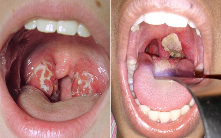 Thông tin mới nhất về sức khỏe bệnh nhân mắc bạch hầu ở Bắc Giang