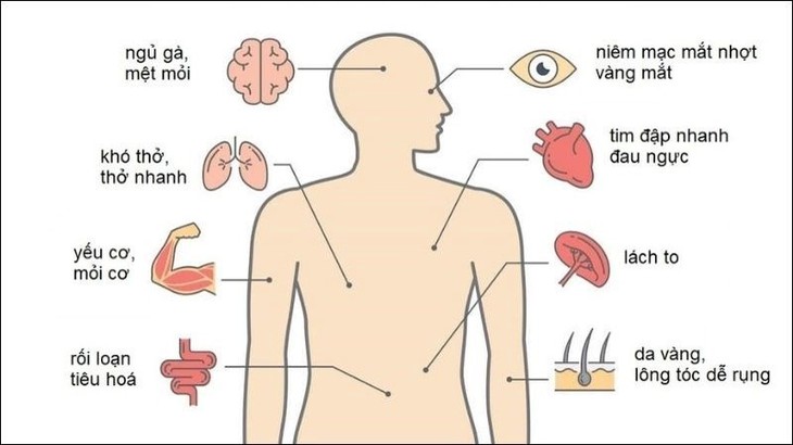 Tan máu bẩm sinh (Thalassemia): Nguyên nhân, triệu chứng và cách điều trị bệnh - Ảnh 3.