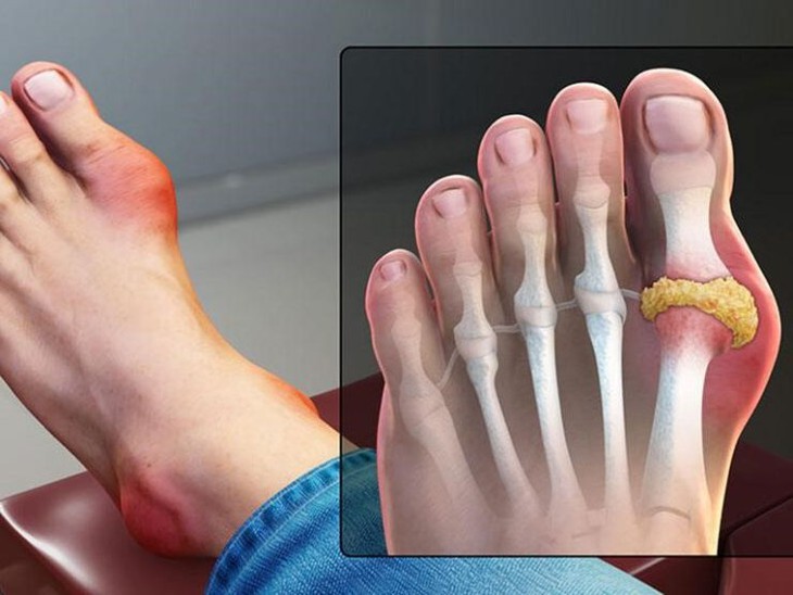 Thực phẩm cần tránh cho người bệnh gout để giảm sưng đau khớp - Ảnh 1.