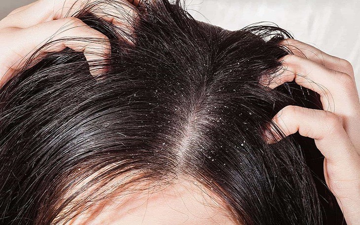 Viêm da tiết bã có gây rụng tóc?- Ảnh 1.