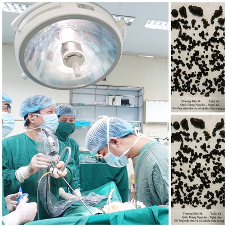 Phẫu thuật nội soi lấy gần 1000 viên sỏi đường mật trong gan- Ảnh 1.