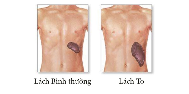 Bài tập tốt cho người bệnh cường lách- Ảnh 1. Bài tập tốt cho người bệnh cường lách- Ảnh 1.