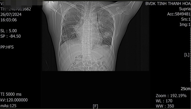 4 giờ ‘cân não’ bác sĩ cứu sống thanh niên vỡ tim, phổi do tai nạn giao thông- Ảnh 1. 4 giờ ‘cân não’ bác sĩ cứu sống thanh niên vỡ tim, phổi do tai nạn giao thông- Ảnh 1.