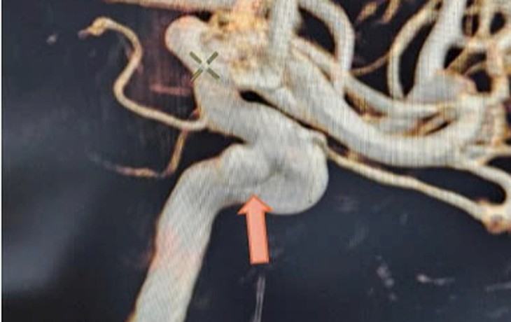 Bệnh viện Hữu nghị đa khoa Nghệ An can thiệp nút coil túi phình thành công cho bệnh nhân bị phình động mạch não- Ảnh 2.
