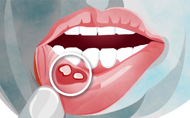 Nguyên nhân và cách khắc phục nhiệt miệng