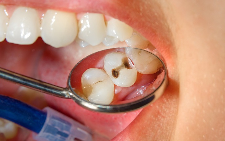 Cách chăm sóc răng miệng để cơ thể khỏe mạnh