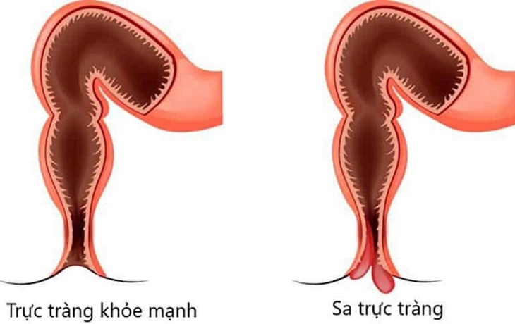 Sa trực tràng: Nguyên nhân, triệu chứng, phòng bệnh và điều trị- Ảnh 1. Sa trực tràng: Nguyên nhân, triệu chứng, phòng bệnh và điều trị- Ảnh 1.