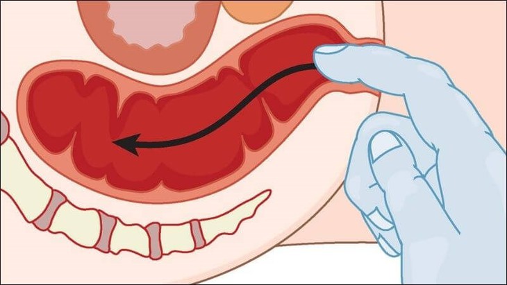 Sa trực tràng: Nguyên nhân, triệu chứng, phòng bệnh và điều trị- Ảnh 3. Sa trực tràng: Nguyên nhân, triệu chứng, phòng bệnh và điều trị- Ảnh 3.