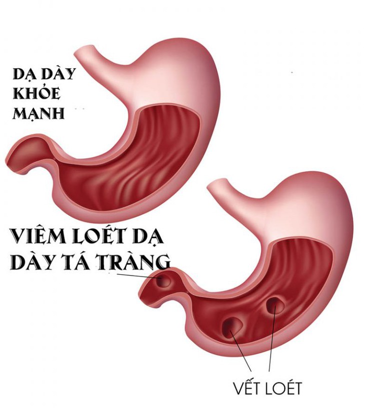 Loét dạ dày tá tràng: Nguyên nhân, triệu chứng, phòng ngừa và cách điều trị- Ảnh 1. Loét dạ dày tá tràng: Nguyên nhân, triệu chứng, phòng ngừa và cách điều trị- Ảnh 1.