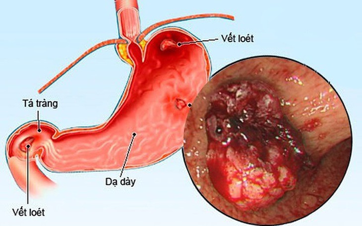 Các thuốc điều trị loét dạ dày tá tràng