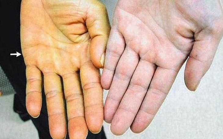 Tắm nước lá chữa ngứa hơn 2 tháng, người đàn ông tổn thương da toàn thân- Ảnh 2.