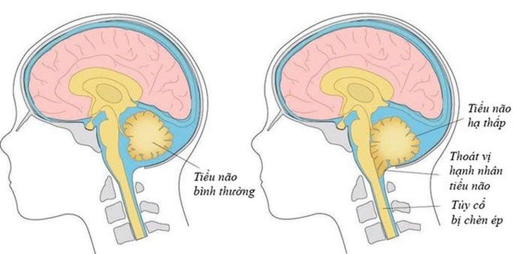 Bệnh viện HNĐK Nghệ An điều trị thành công bệnh nhân mắc hội chứng Arnold chiari hiếm gặp- Ảnh 1.