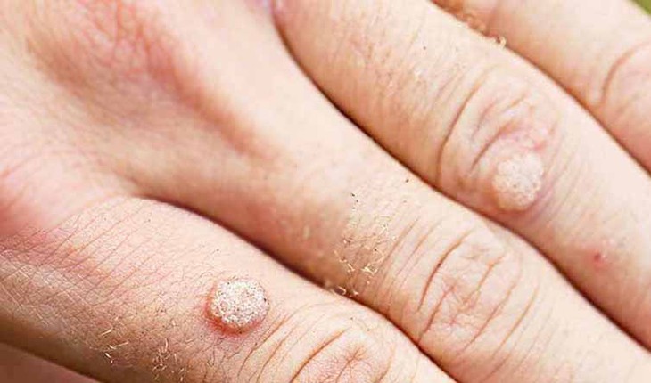 Mụn cóc: Nguyên nhân, triệu chứng, cách điều trị và phòng bệnh- Ảnh 1. Mụn cóc: Nguyên nhân, triệu chứng, cách điều trị và phòng bệnh- Ảnh 1.