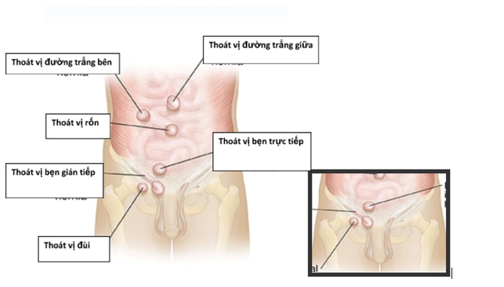 Thoát vị bẹn người lớn: Nguyên nhân, triệu chứng, phòng bệnh và điều trị- Ảnh 2. Thoát vị bẹn người lớn: Nguyên nhân, triệu chứng, phòng bệnh và điều trị- Ảnh 2.