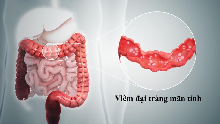 Các phương pháp điều trị viêm đại tràng mạn tính- Ảnh 1. Các phương pháp điều trị viêm đại tràng mạn tính- Ảnh 1.