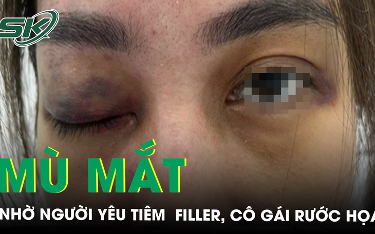 Mù mắt vì nhờ người yêu tiêm filler 