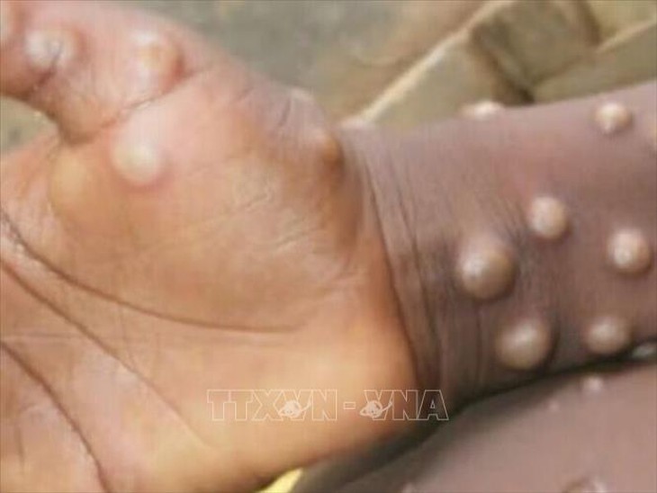 Giới khoa học đánh giá nguyên nhân bùng phát bệnh đậu mùa khỉ ở châu Phi- Ảnh 1. Giới khoa học đánh giá nguyên nhân bùng phát bệnh đậu mùa khỉ ở châu Phi- Ảnh 1.
