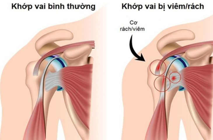Khớp vai là một khớp lồi cầu – ổ chảo, chỏm xương cánh tay gắn vào ổ chảo xương bả vai nhờ chóp xoay và bao khớp.