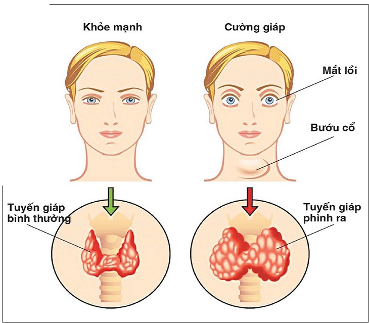 Dùng nhầm thuốc điều trị basedow dẫn đến nguy cơ tử vong- Ảnh 1. Dùng nhầm thuốc điều trị basedow dẫn đến nguy cơ tử vong- Ảnh 1.