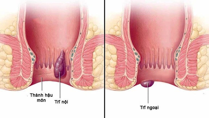 Chế độ ăn cho người mắc bệnh trĩ, nên ăn gì để tốt cho quá trình điều trị?- Ảnh 2.