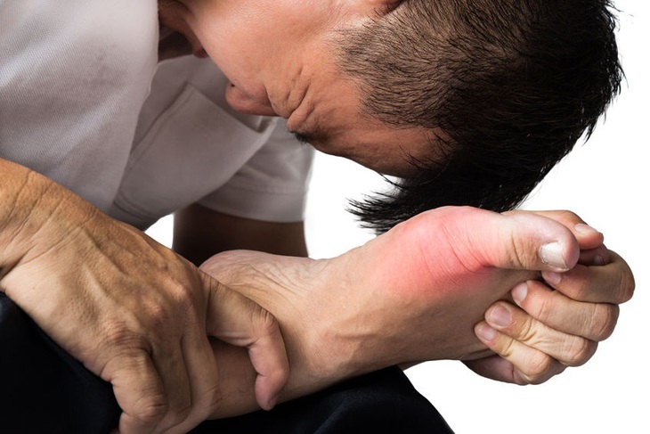 Thời tiết nắng nóng cẩn thận với cơn gout cấp- Ảnh 2.