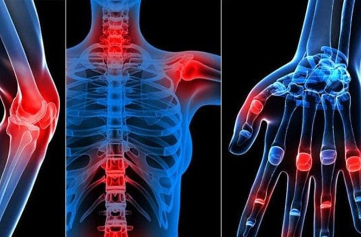 Viêm khớp dạng thấp ảnh hưởng đến cơ thể như thế nào?- Ảnh 1.