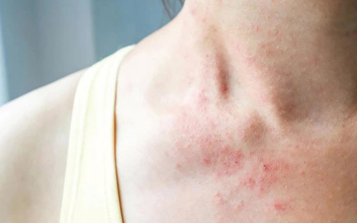 Nhận biết các loại chàm da thường gặp