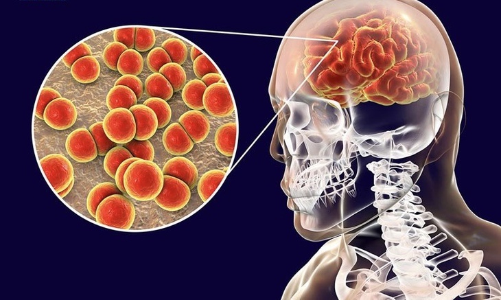 Viêm não, viêm màng não là những bệnh lý nhiễm trùng màng bao phủ não, nguyên nhân hầu hết bệnh là do virus gây ra, tỷ lệ biến chứng và tử vong cao. Viêm não, viêm màng não là những bệnh lý nhiễm trùng màng bao phủ não, nguyên nhân hầu hết bệnh là do virus gây ra, tỷ lệ biến chứng và tử vong cao.