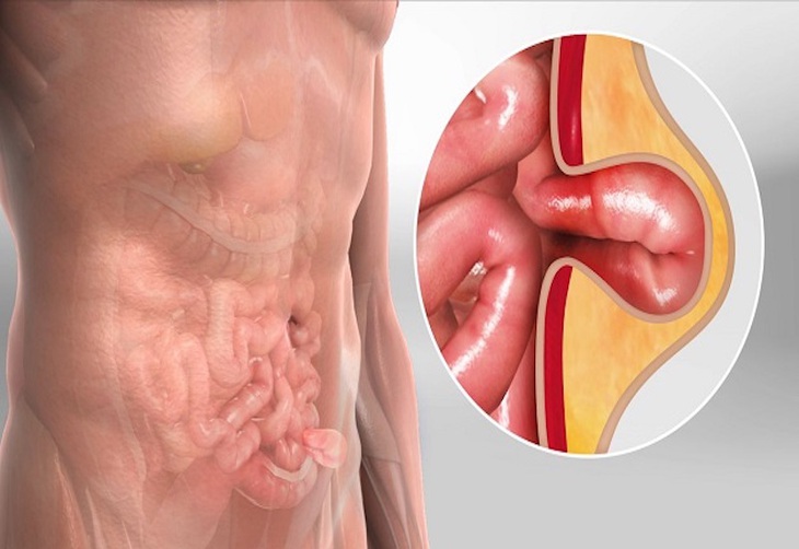 Câu hỏi thường gặp liên quan đến bệnh thoát vị bẹn người lớn- Ảnh 1. Câu hỏi thường gặp liên quan đến bệnh thoát vị bẹn người lớn- Ảnh 1.