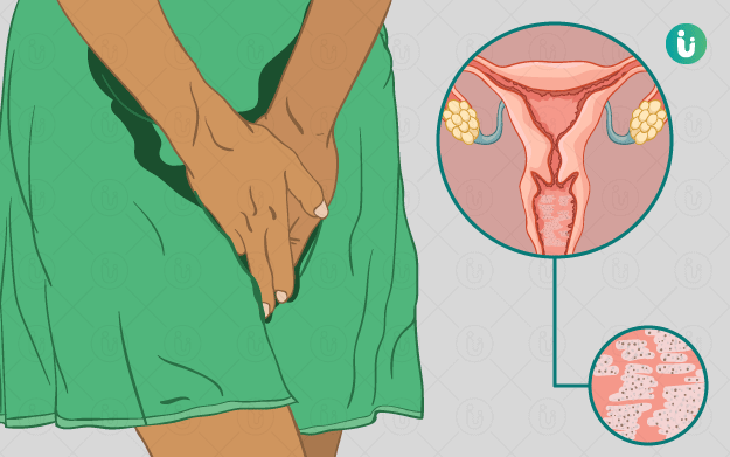 Phòng bệnh viêm phụ khoa dễ mắc trong mùa mưa lũ