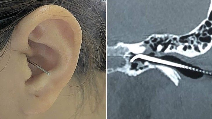 Một trường hợp tổn thương tai do dùng dụng cụ lấy ráy tai