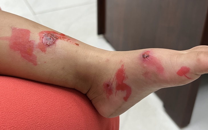 Bác sĩ da liễu cảnh báo nguy cơ lây lan bệnh chốc ở trường học 