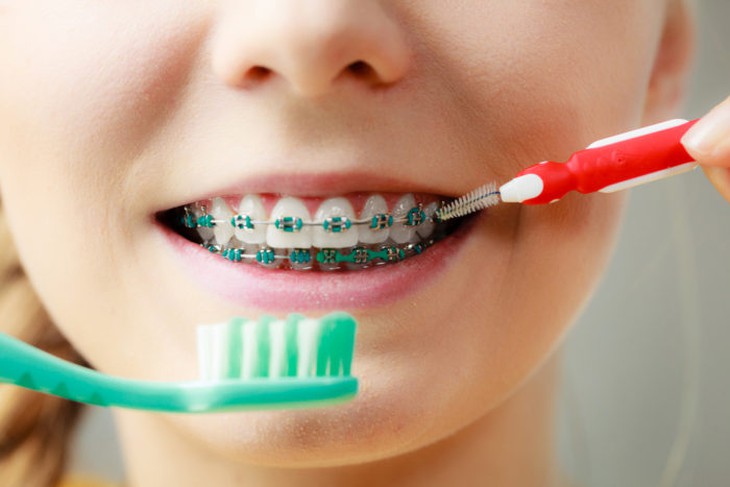 Một số lưu ý khi niềng răng để hàm răng luôn trắng khoẻ- Ảnh 1. Một số lưu ý khi niềng răng để hàm răng luôn trắng khoẻ- Ảnh 1.