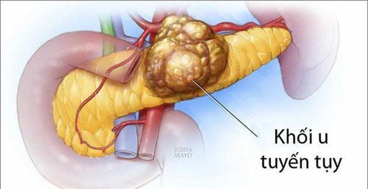 6 dấu hiệu ung thư tụy, nhận biết sớm để điều trị kịp thời- Ảnh 1. 6 dấu hiệu ung thư tụy, nhận biết sớm để điều trị kịp thời- Ảnh 1.