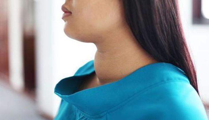 Thuốc và các biện pháp điều trị bệnh basedow ở người lớn- Ảnh 1.