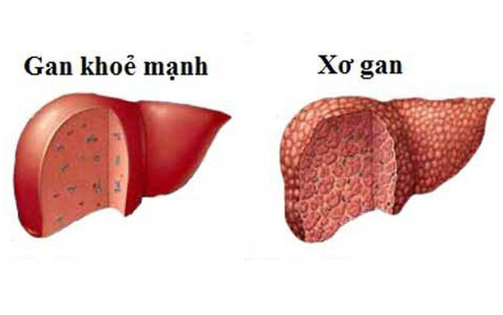 Biểu hiện nhận biết các giai đoạn của bệnh xơ gan