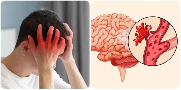 Bất kỳ ai cũng có nguy cơ đột quỵ.
