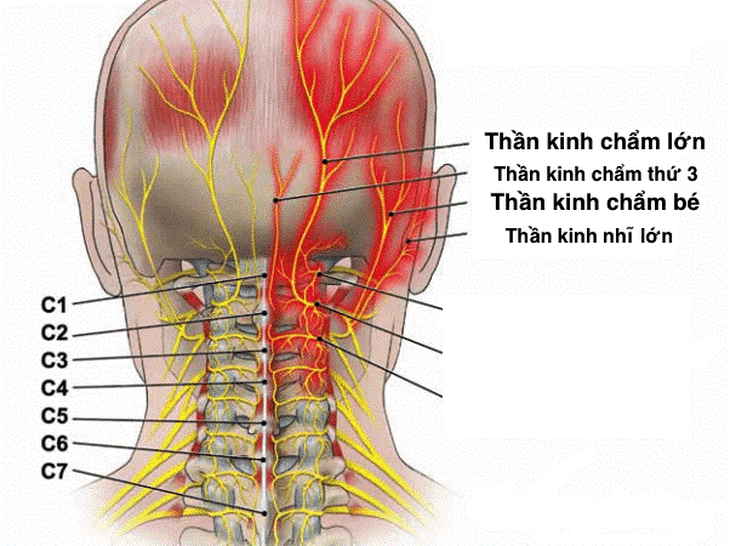 Các biện pháp điều trị đau dây thần kinh chẩm- Ảnh 1. Các biện pháp điều trị đau dây thần kinh chẩm- Ảnh 1.
